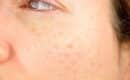 Comment enlever taches brunes visage naturellement ?