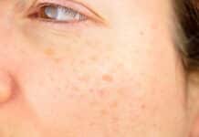 Comment enlever taches brunes visage naturellement ?