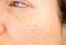 Comment enlever taches brunes visage naturellement ?