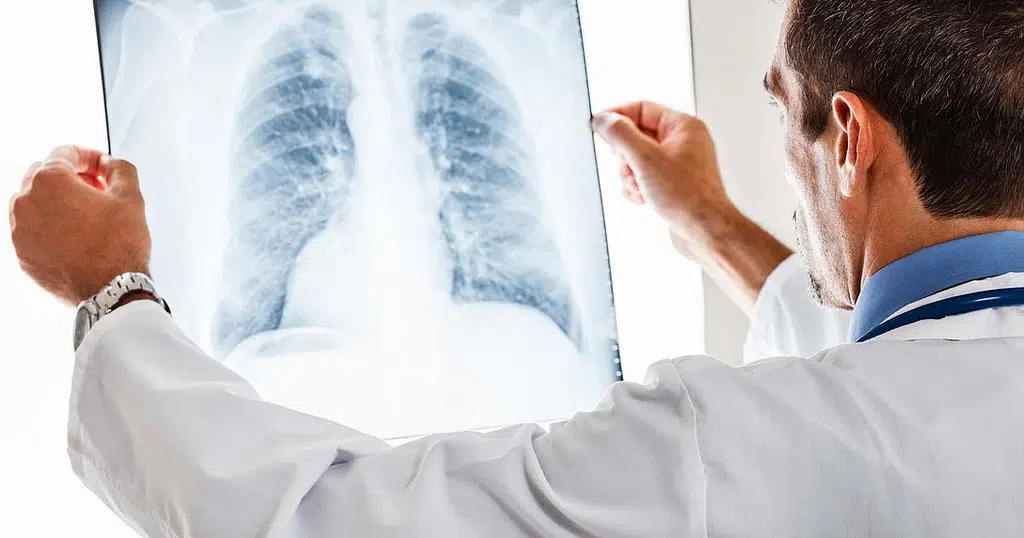 lung cancer awareness 