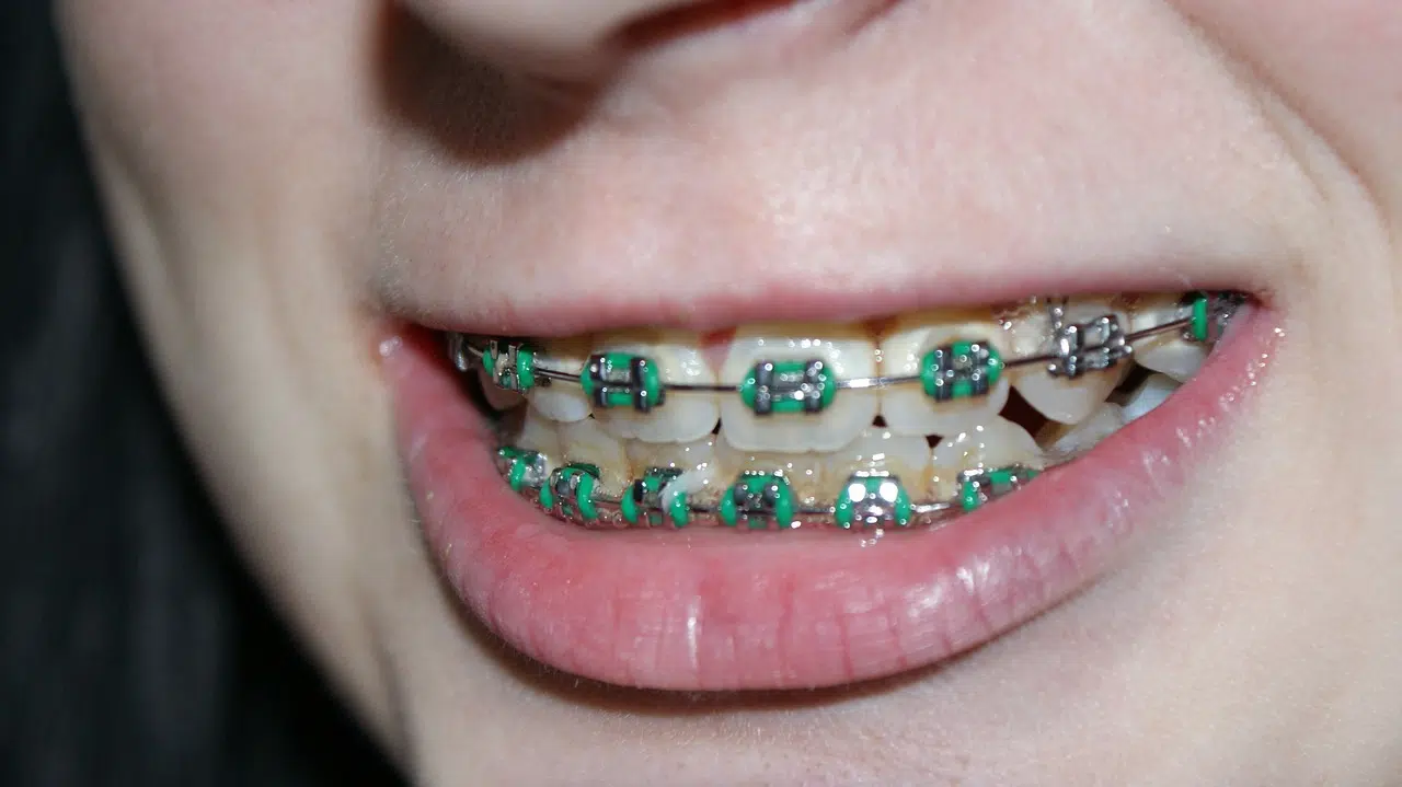 Advanced Orthodontics Helps to Correct Teeth Structure, Jaw and Gum Problems